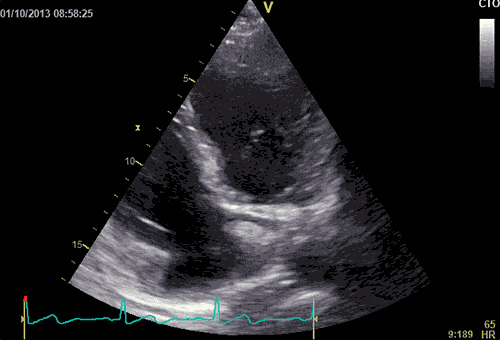 Animation einer Herz Ultraschall Sequenz